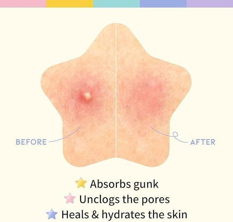 30 Pcs Pimple Patches